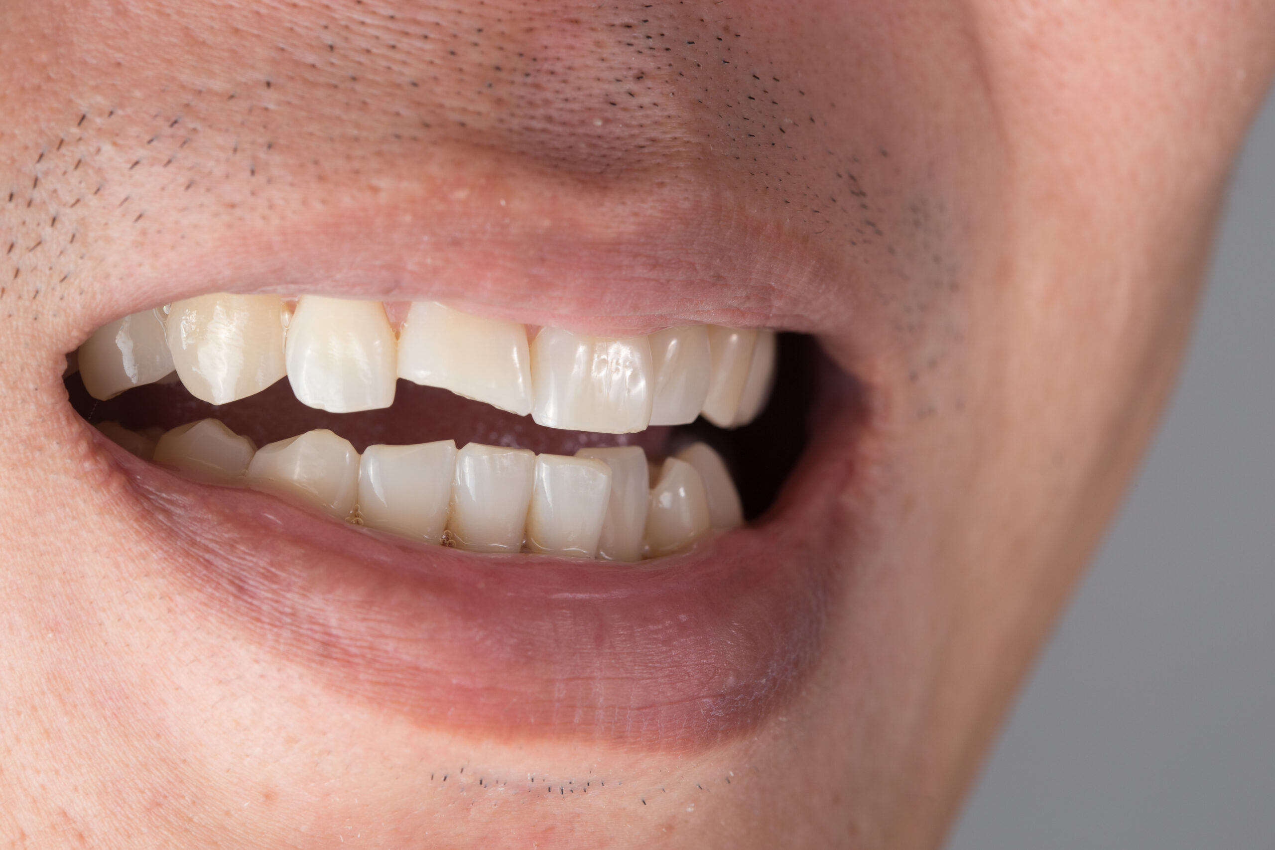 Man holding his mouth in pain from a dental injury